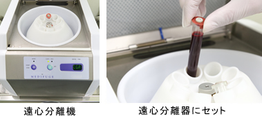 再生医療の最先端 CGF治療