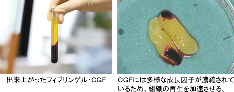再生医療の最先端 CGF治療