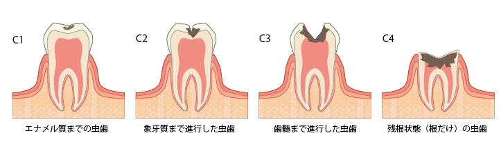虫歯には4段階の状態があります