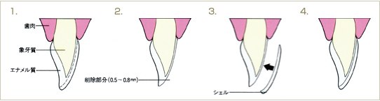 ラミネートベニアとは
