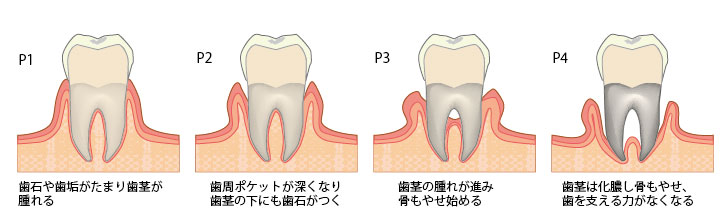 歯周病とは