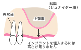 ソケットリフト_前
