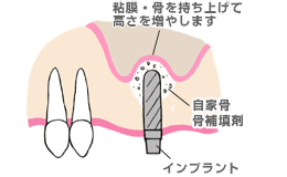 ソケットリフト_後
