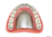 総入れ歯