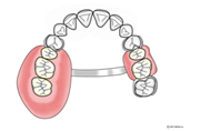部分入れ歯