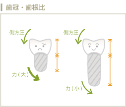 歯冠・歯根比