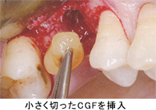 骨補填材と混ぜて使用