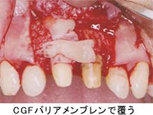 メンブレンのかわりに使用する