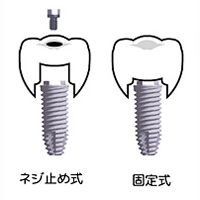 ネジ止め式インプラント