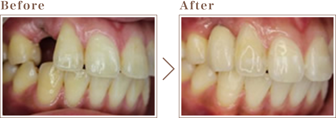このように失われた歯を回復しています