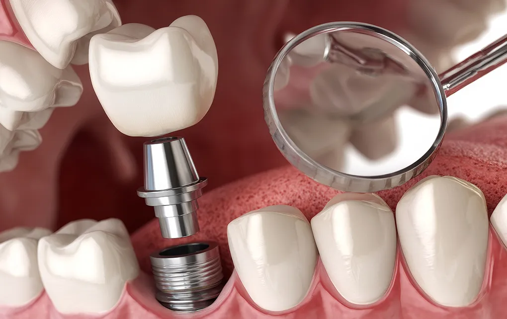 即時荷重インプラント