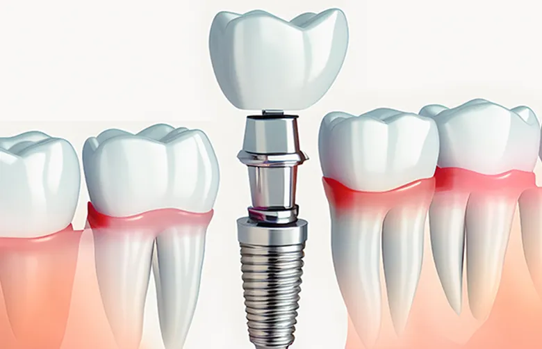 即時荷重インプラント