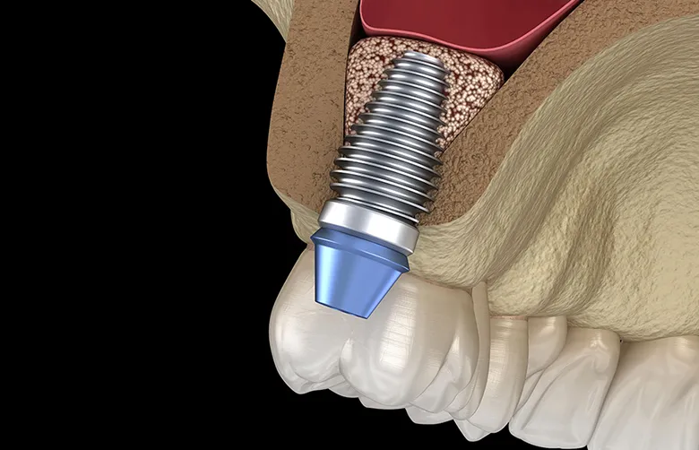 骨の少ない方への治療