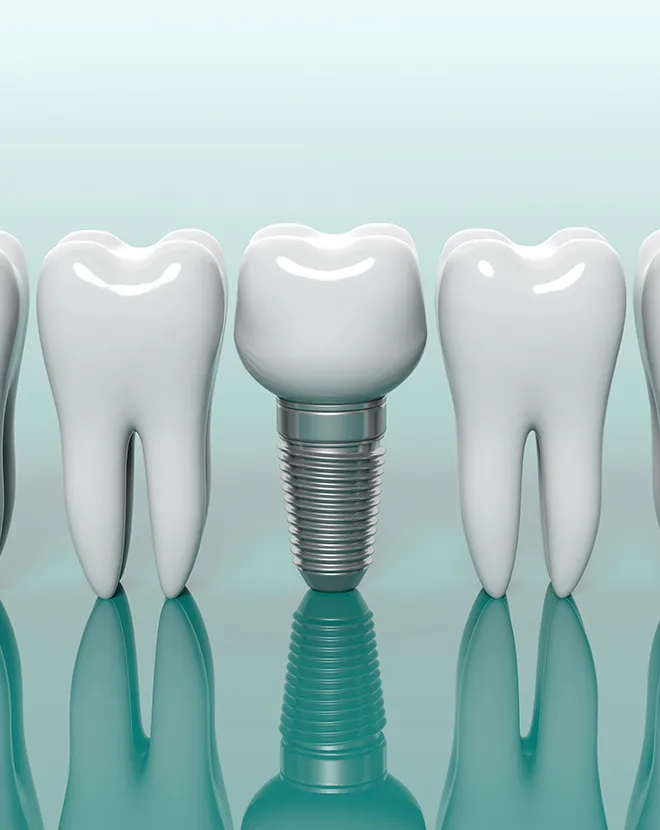 インプラント治療