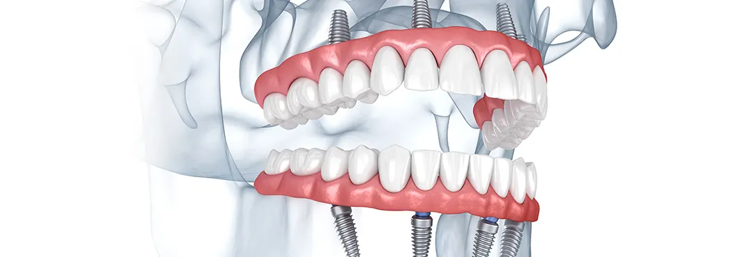 「All-on-4/6」とは