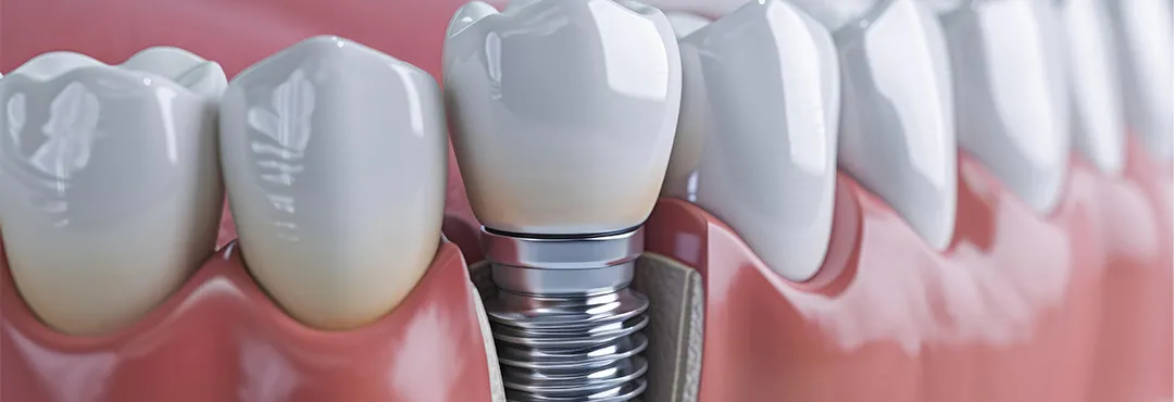 インプラント治療とは