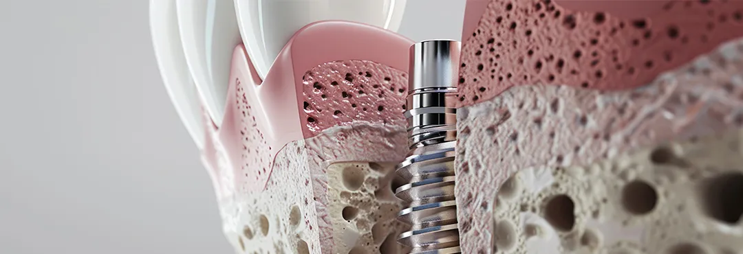 骨の少ない方への治療