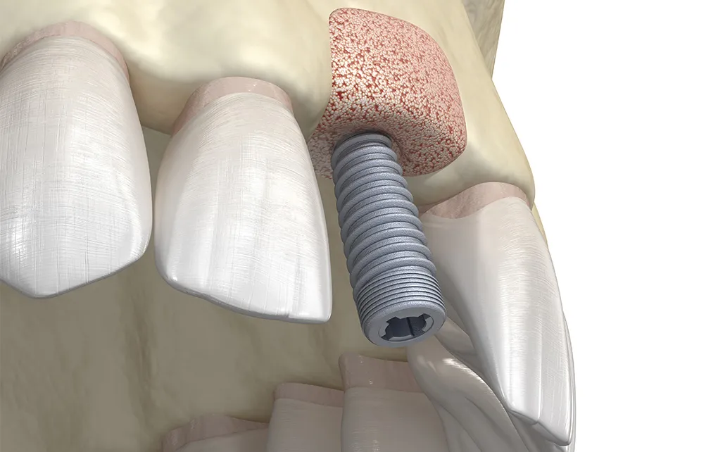 サイナスリフト