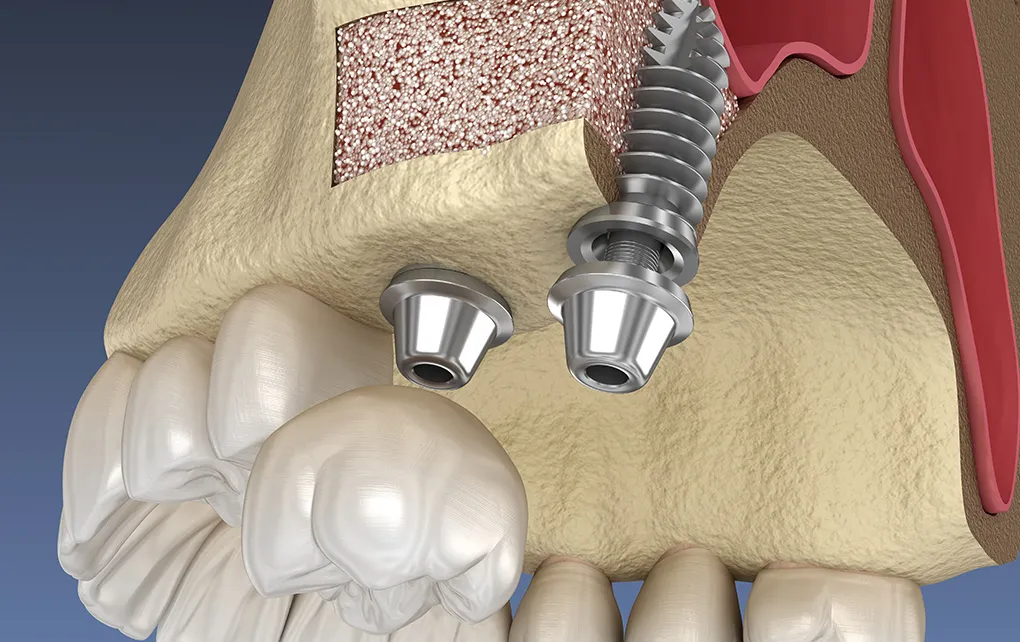 ソケットリフト
