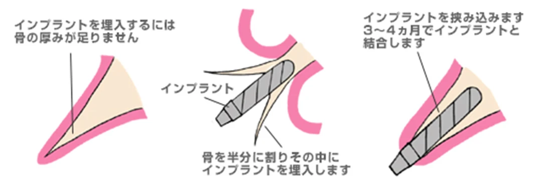 スプリットクレスト