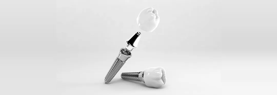 インプラント治療