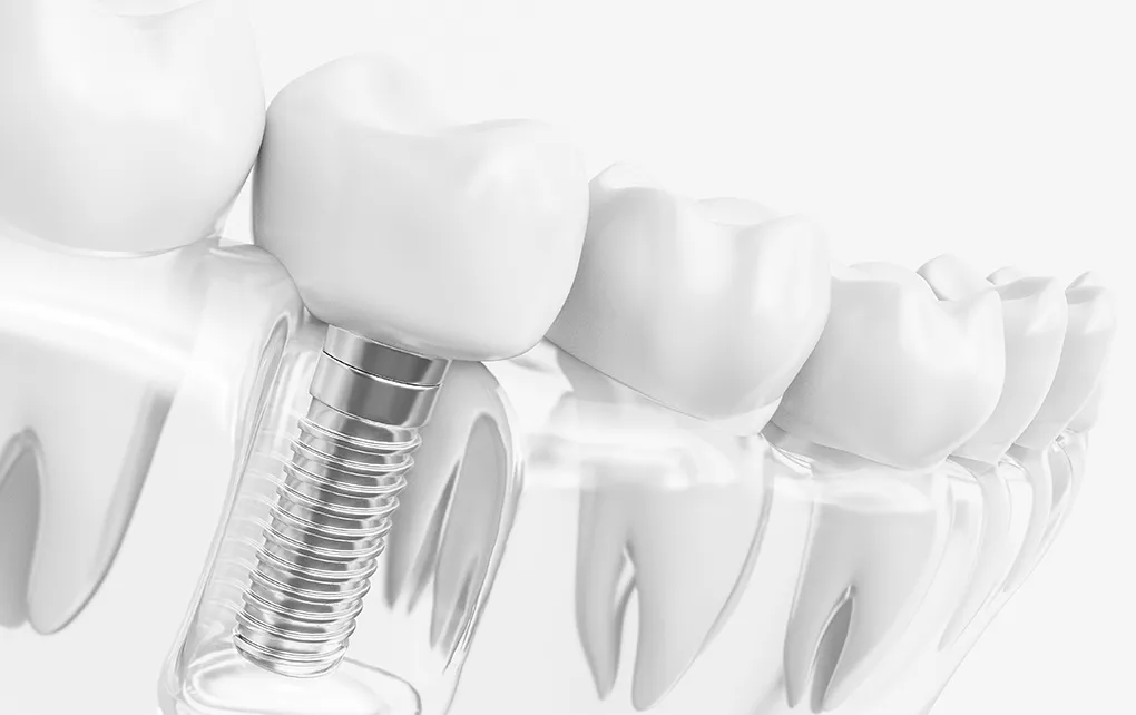 インプラント治療とは