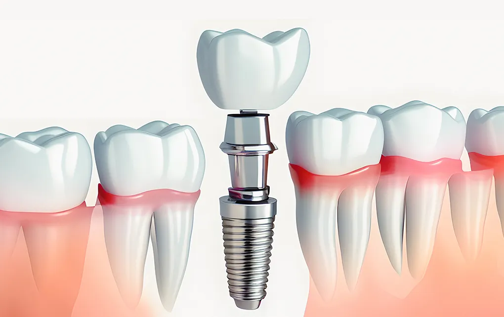 即時荷重インプラント