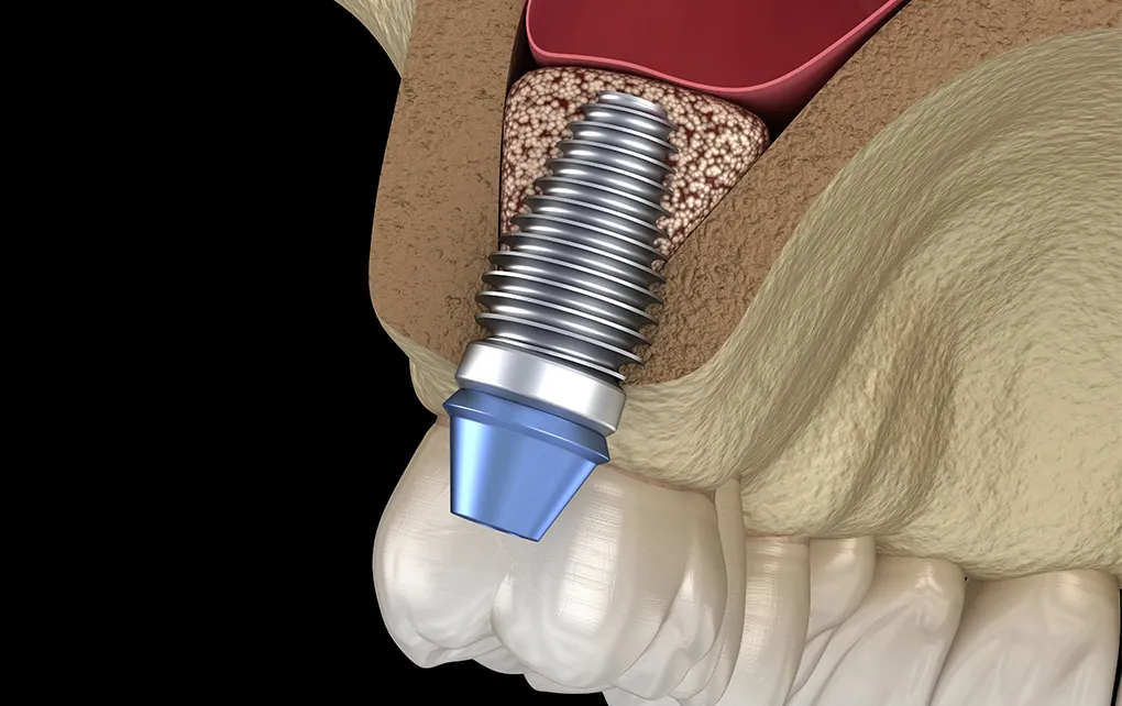 骨の少ない方への治療