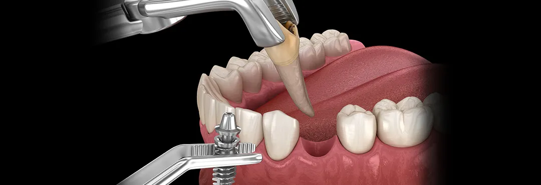 即時荷重インプラント