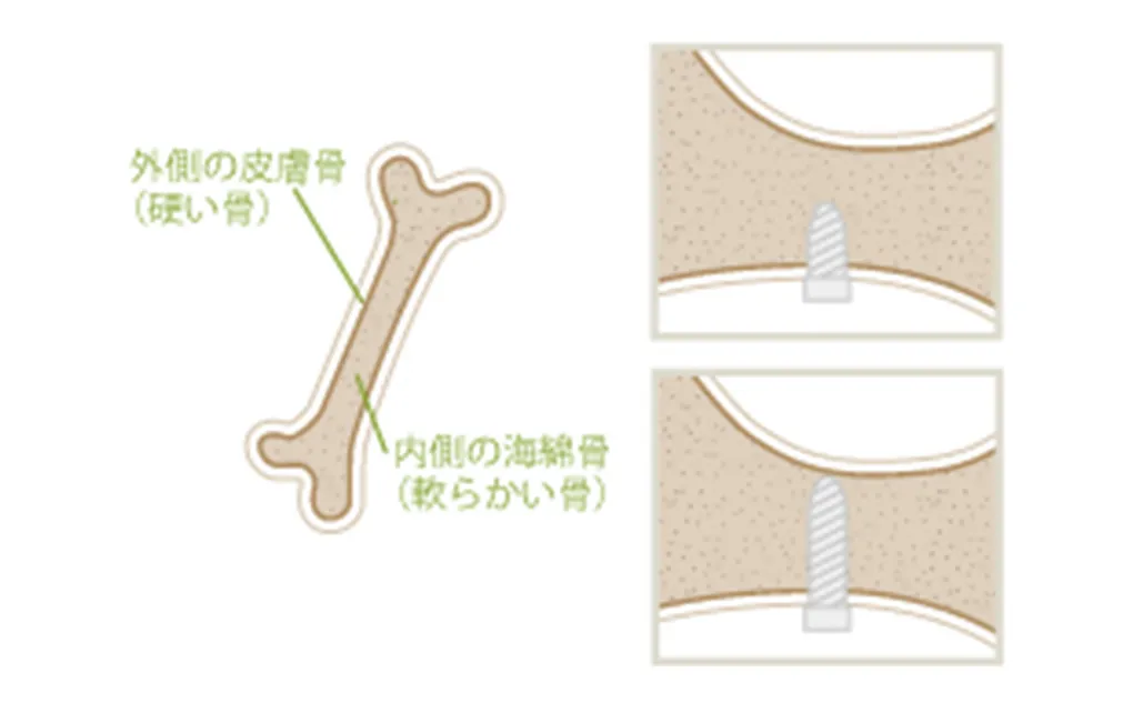「バイ・コーティカル・サポート」