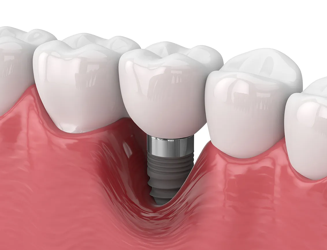 インプラント周囲炎