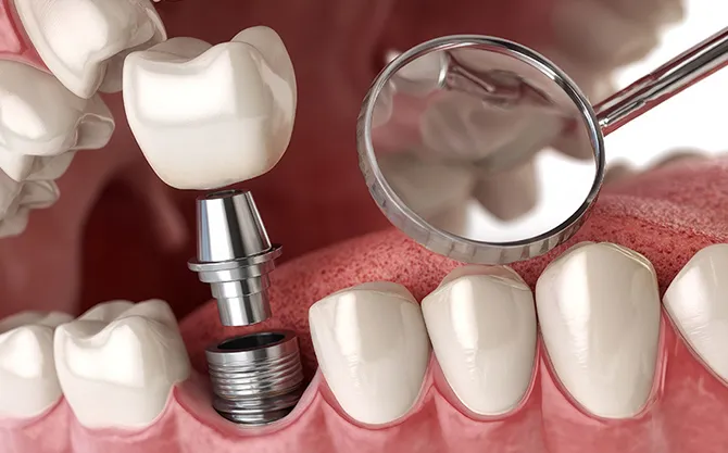 即時荷重インプラント