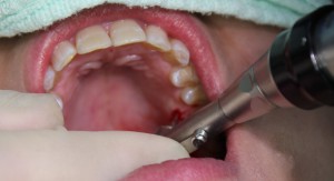 インプラントアンカースクリュー