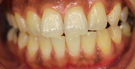 ブライダルホワイトニング