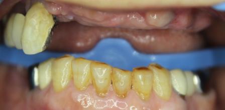 初!!ホワイトニング4回コース