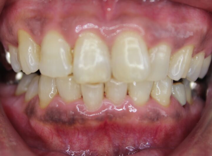 ガムピーリング