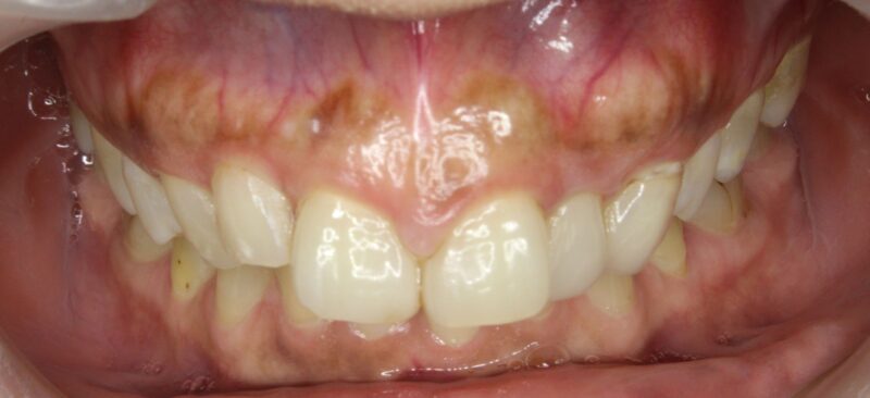 ガムピーリングでピンク歯肉