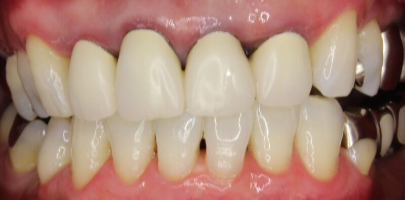 ホワイトニングでツルツルピカピカ