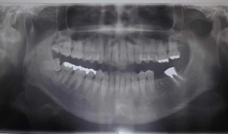 親しらずの抜歯