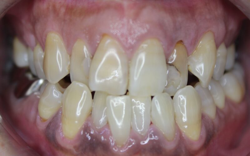 テトラサイクリン変色歯のホワイトニング