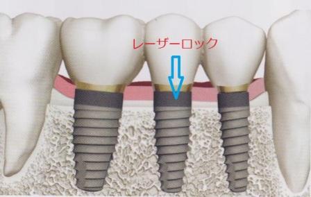 インプラント学会に行ってきました