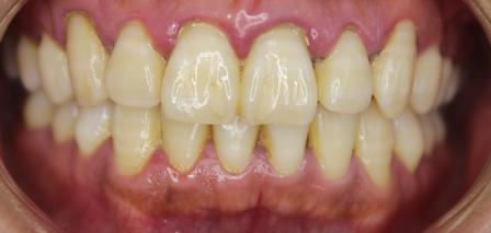 虫歯がなくても、恐ろしい・・・