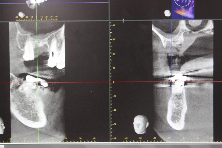 インプラントと骨再生