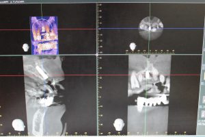 今日もインプラントのオペでした