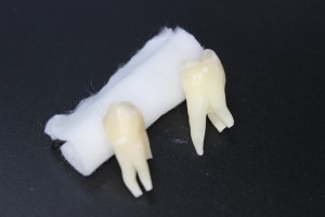 なんと歯根が…