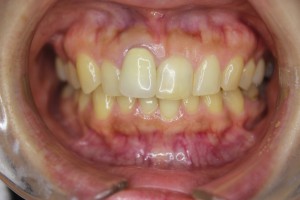 テトラサイクリン変色歯