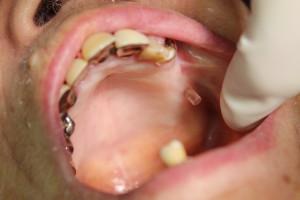 根管治療器Smart plus