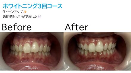 初めてのホワイトニング🦷